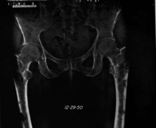 Anteroposterior view of the pelvis and upper parts of the femurs of the patient