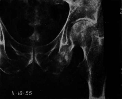 Anteroposterior view of the pelvis of a patient with an adenocarcinoma of the bladder