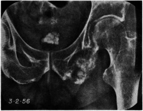 Anteroposterior view of the pelvis of patient of Fig. 185, 4 months later