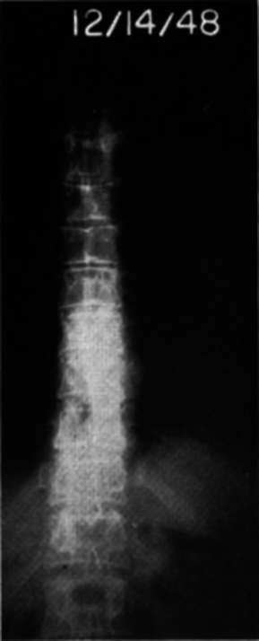 Anteroposterior views of thoracic spine in Case E.M