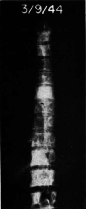 Anteroposterior views of thoracic spine in Case E.M.