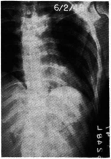 Arterioposterior view of the chest of patient 5 months later