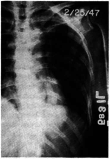 Arterioposterior view of the chest of patient