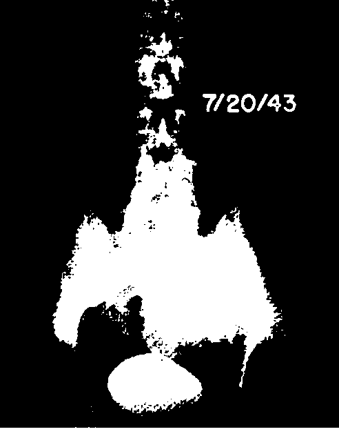 Cystogram of patient H.A., after treatment with ethyl mercaptan