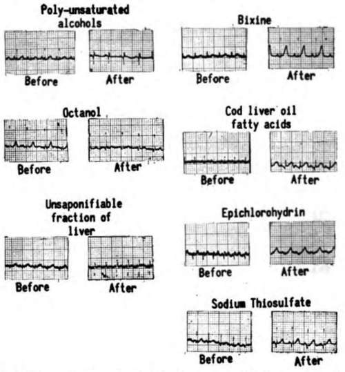 Electrocardiograms