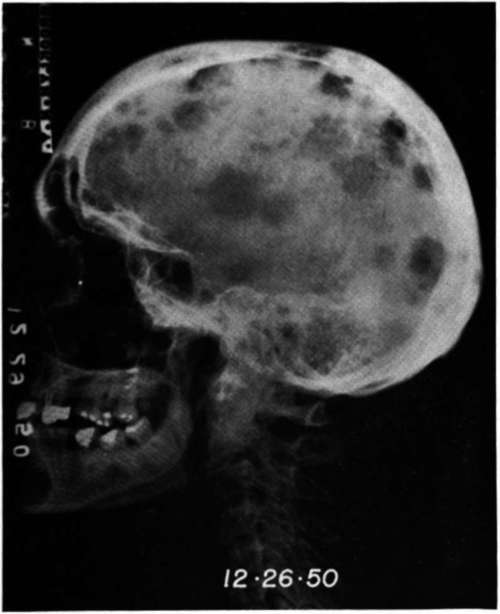 Lateral view of the skull of patient (B.T.) at the time of admission