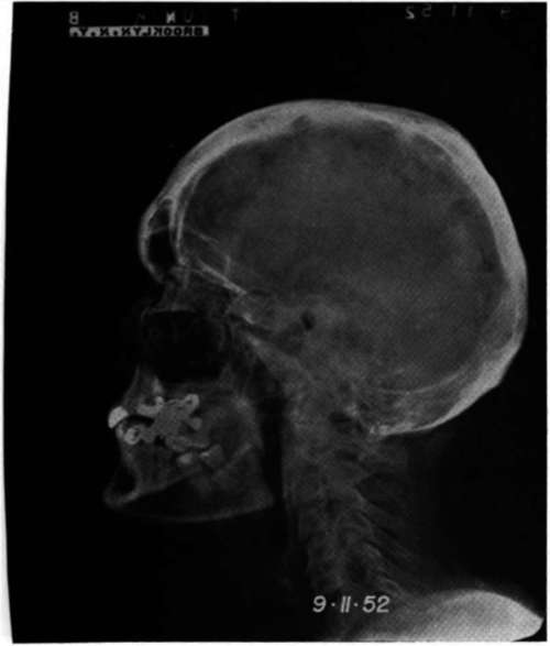 Lateral view of the skull of patient (B.T.)