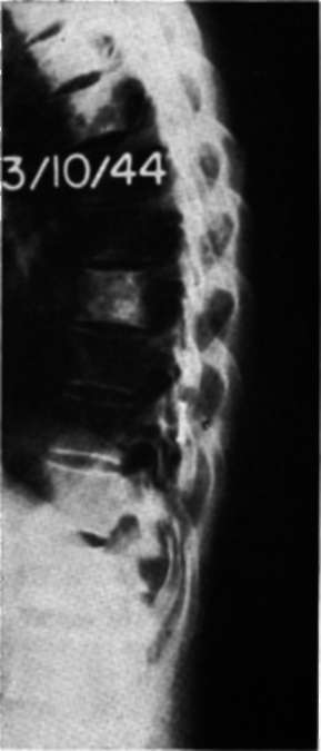 Lateral view of the thoracic spine in Case E.M. at time of admission