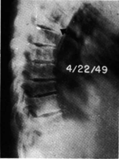 Lateral view of thoracic spine in Case E.H. four months after beginning of treatment