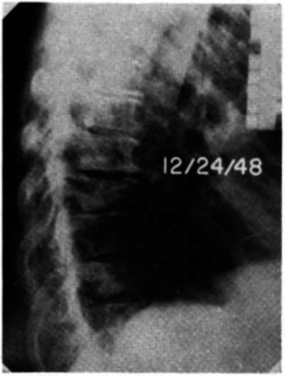 Lateral view of thoracic spine in Case E.H.