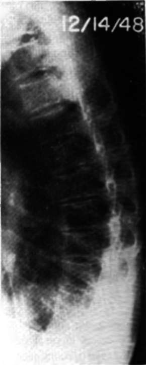 Lateral view of thoracic spine in Case E.M., fifty seven months after onset of therapy