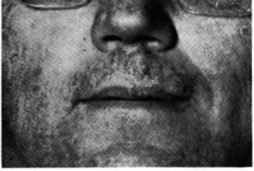 Patient G.Z. after treatment
