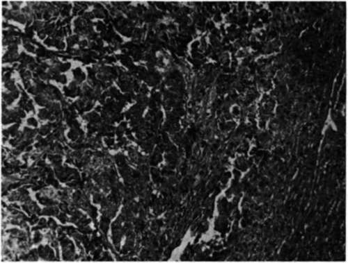 Photomicrograph of a liver biopsy of patient J.D