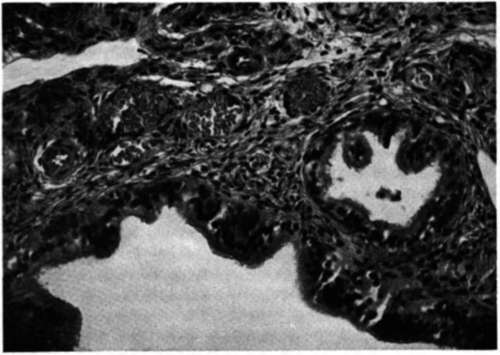 Photomicrograph of a lymph node biopsied from patient M.B. showing metastatic adenocarcinoma
