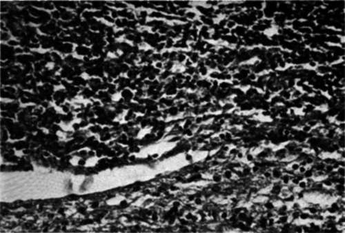 Photomicrograph of a lymph node of patient M.S. showing a lymphosarcoma