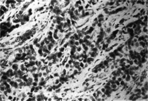 Photomicrograph of recurrent skin nodule in Case E.M