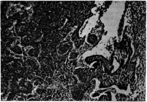 Photomicrograph of the biopsy made on patient M.McB. showing a basocellular carcinoma