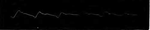 Fig. 316. Pulse of a Tobacco-User.