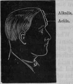 Fig. 165.   Showing the position of the frontal headaches relieved by acids and alkalis in the absence of constipation. The lower is relieved by acids, the upper by alkalis before meals.