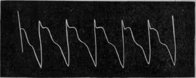 Fig. 173.   Normal pulse tracing of a patient suffering from aortic regurgitation and angina pectoris.