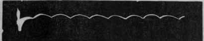 Fig. 174.   Tracing of the same pulse during severe anginal pain.