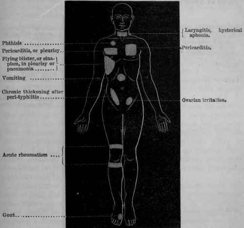 Fig. 226.   Diagram of the body showing some of the points where blisters or sinapisms are usually