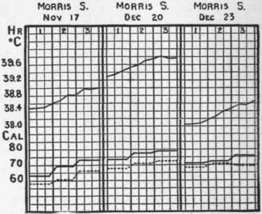 Curves showing the relationship and heat elimination in fever Rising temperature.
