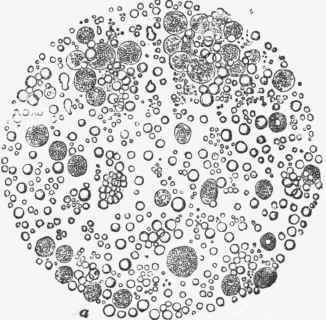 Microscopic appearance of milk in the early stage of lactation, showing colostrum cells (a).