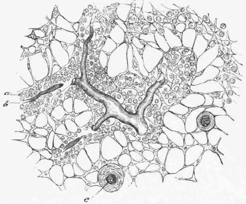 Section through the central or medullary part of a Lymphatic Gland, showing adenoid tissue.