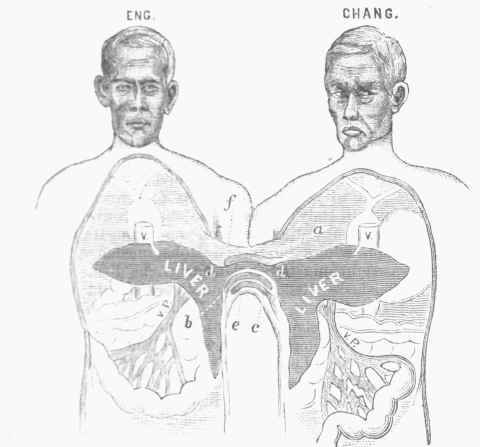 The Siamese Twins.